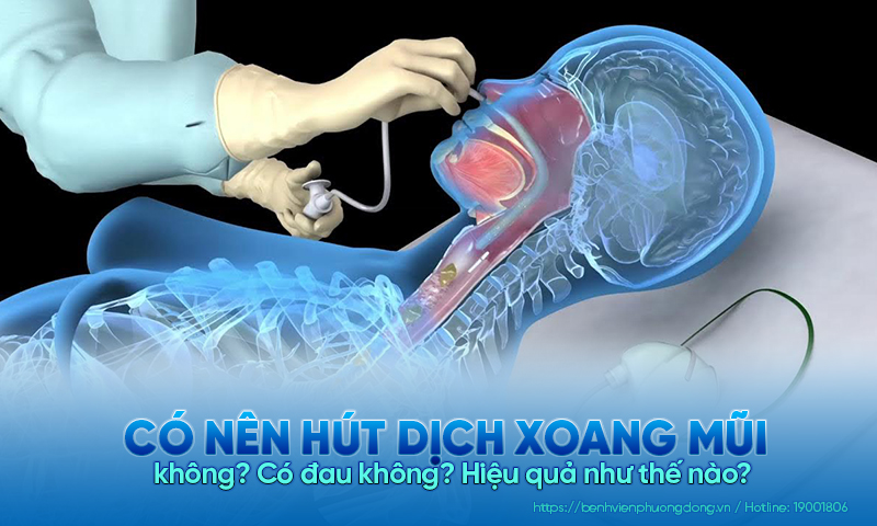 Có nên hút dịch xoang mũi không? Có đau không? Hiệu quả như thế nào?