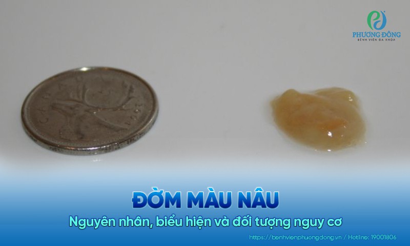 Đờm màu nâu: Nguyên nhân, biểu hiện và đối tượng nguy cơ