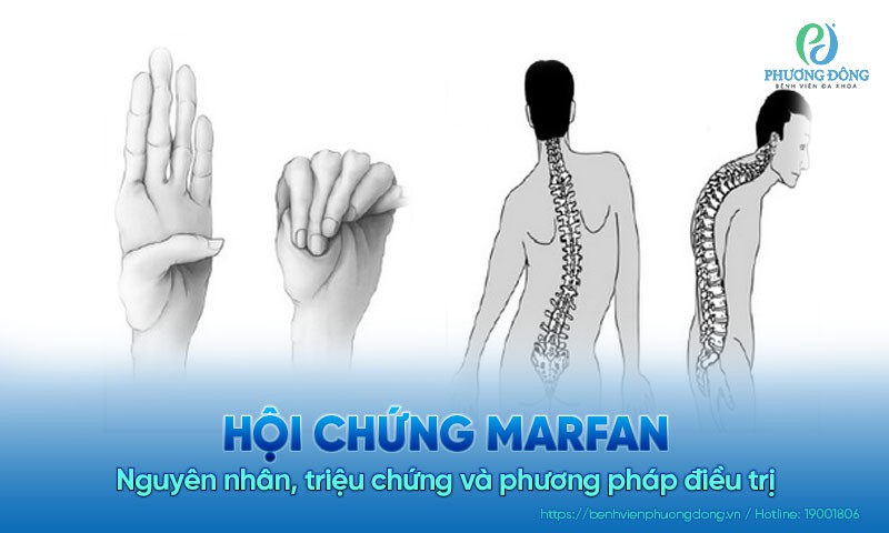 Hội chứng Marfan: Nguyên nhân, triệu chứng và phương pháp điều trị