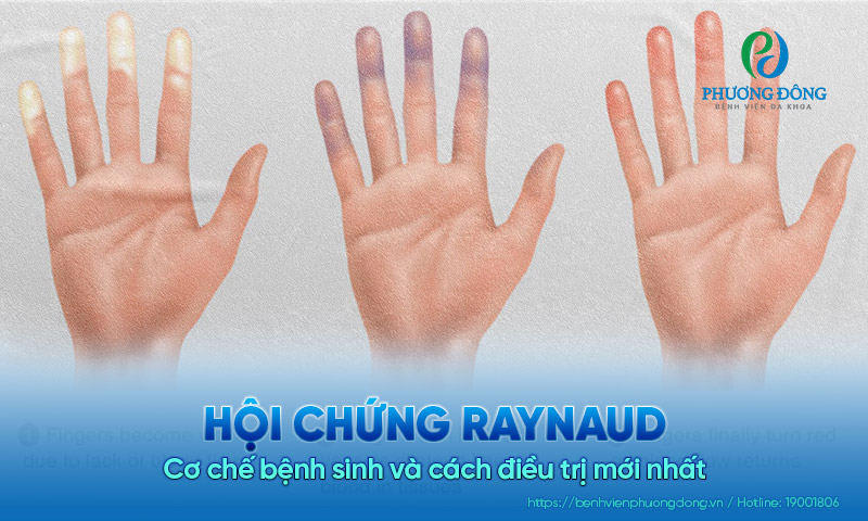 Hội chứng Raynaud: Cơ chế bệnh sinh và cách điều trị mới nhất