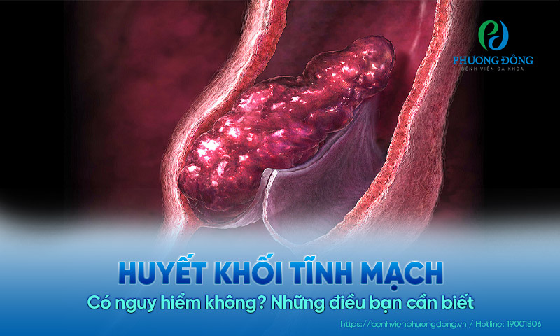 Huyết khối tĩnh mạch có nguy hiểm không? Những điều bạn cần biết