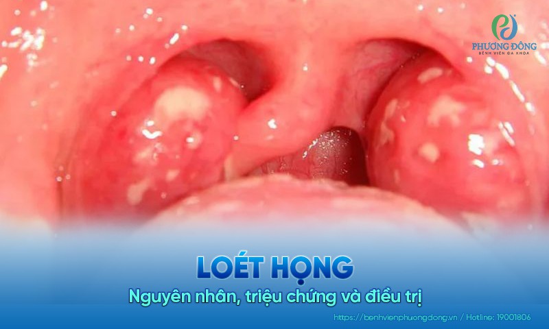 Loét họng: Nguyên nhân, triệu chứng và điều trị