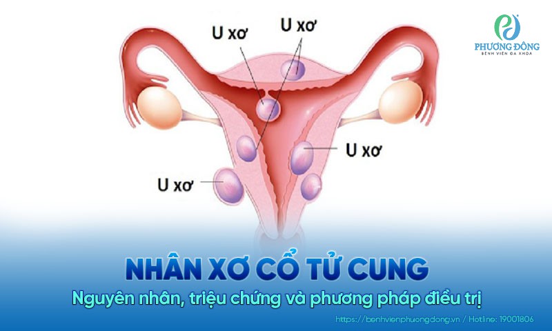 Nhân xơ cổ tử cung: Nguyên nhân, triệu chứng và phương pháp điều trị