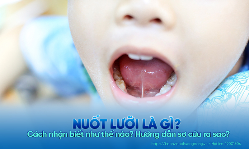 Nuốt lưỡi là gì? Cách nhận biết như thế nào? Hướng dẫn sơ cứu ra sao?