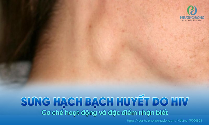 Sưng hạch bạch huyết do HIV: Cơ chế hoạt động và đặc điểm nhận biết