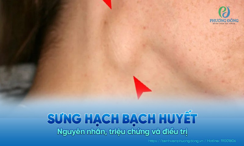 Sưng hạch bạch huyết: Nguyên nhân, triệu chứng và điều trị