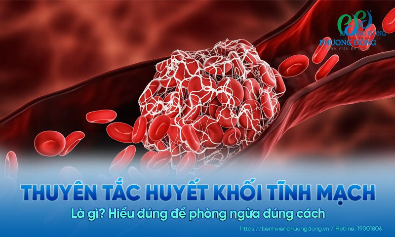 Thuyên tắc huyết khối tĩnh mạch là gì? Hiểu đúng để phòng ngừa đúng cách