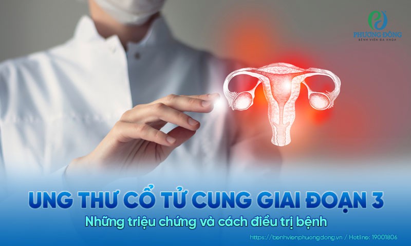 Ung thư cổ tử cung giai đoạn 3: Những triệu chứng và cách điều trị bệnh