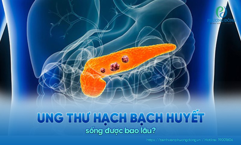 Ung thư hạch bạch huyết sống được bao lâu?