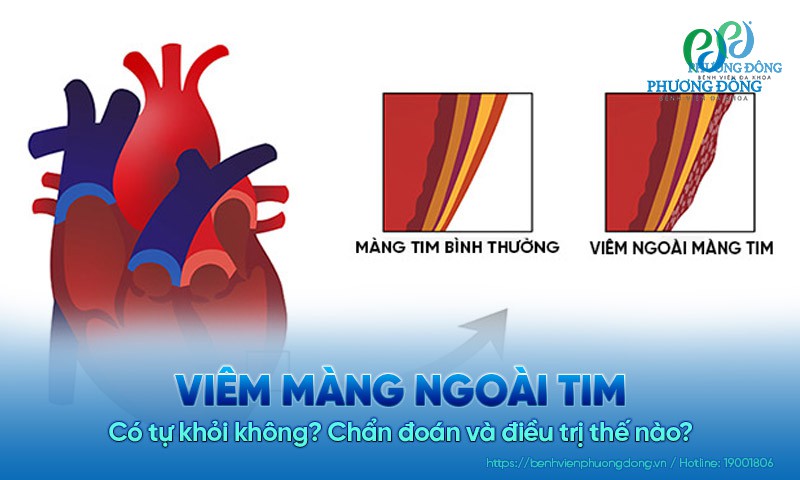 Viêm màng ngoài tim có tự khỏi không? Chẩn đoán và điều trị thế nào?