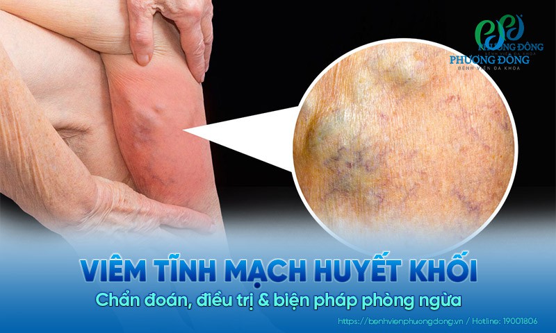 Viêm tĩnh mạch huyết khối: Chẩn đoán, điều trị và biện pháp phòng ngừa