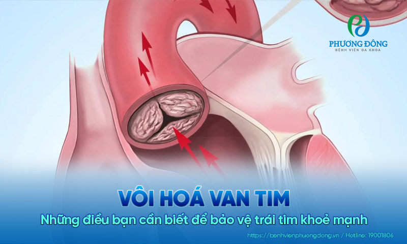 Vôi hoá van tim: Những điều bạn cần biết để bảo vệ trái tim khỏe mạnh