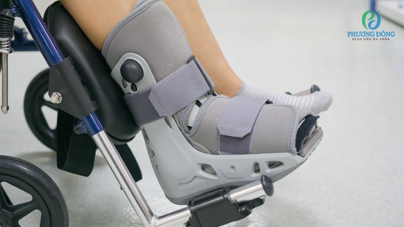 Không tự ý tháo nẹp là một trong 10 điều tránh sau mổ dây chằng chéo