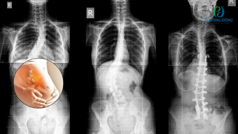 Hỏi đáp với bác sĩ: Vẹo cột sống có mang thai được không?