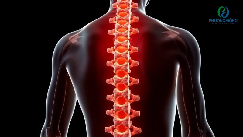 Hỏi đáp với bác sĩ: Bị xẹp đốt sống lưng nên ăn gì?