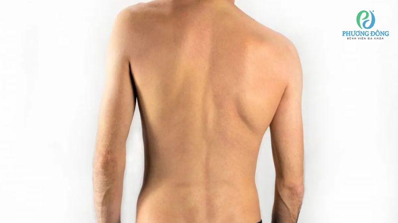 Vẹo cột sống tiến triển có thể khiến người bệnh suy giảm chất lượng đời sống\