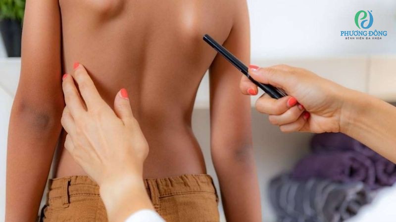 Bác sĩ Xương khớp giải đáp: Vì sao trẻ em dễ bị cong vẹo cột sống?