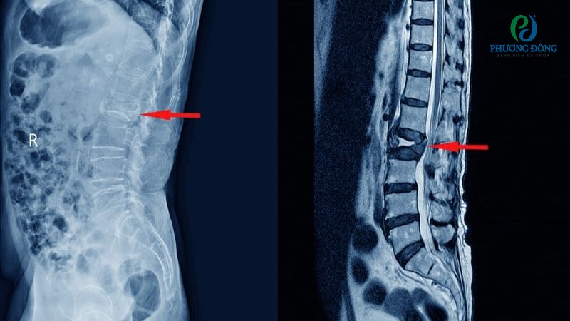 Giải đáp cùng bác sĩ: Xẹp đốt sống có chữa được không?