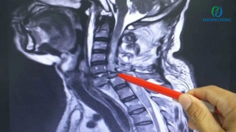 Gai cột sống cổ giai đoạn nặng có thể gây những hệ lụy nghiêm trọng