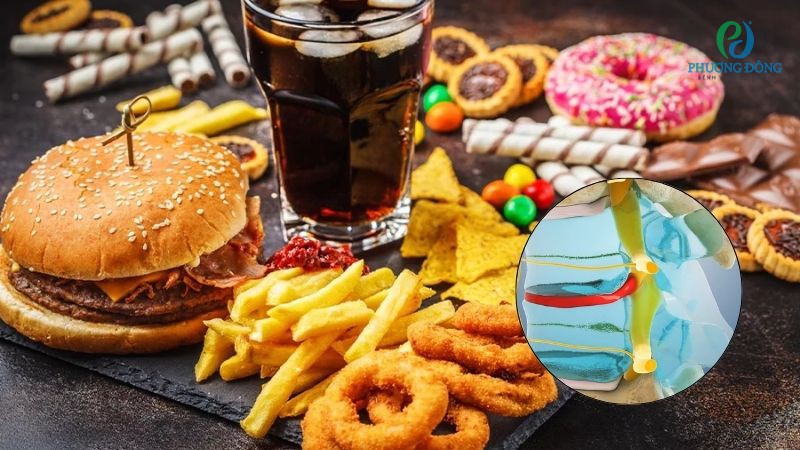 Những nhóm thực phẩm người bệnh gai cột sống cổ cần tránh