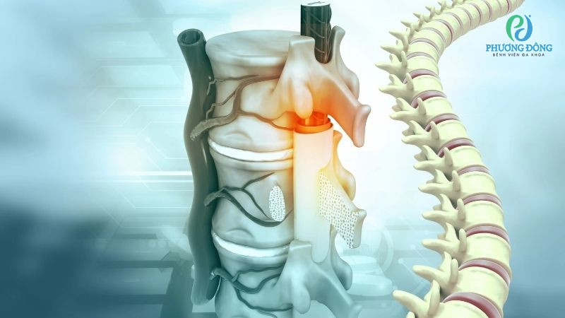 Hỏi - Đáp với bác sĩ: Gai cột sống lưng có chữa được không?