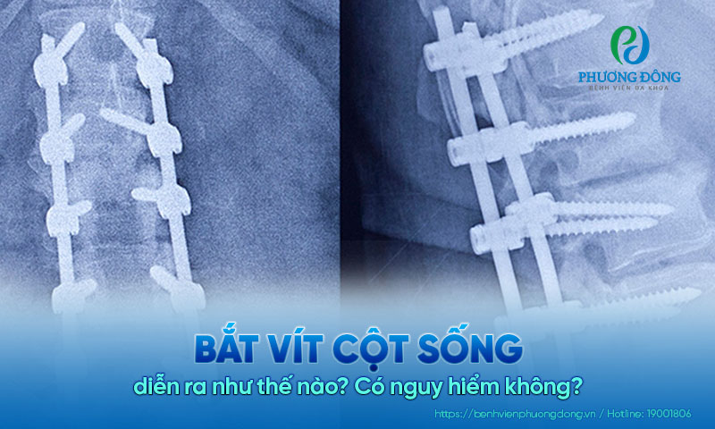 Bắt vít cột sống diễn ra như thế nào? Có nguy hiểm không?