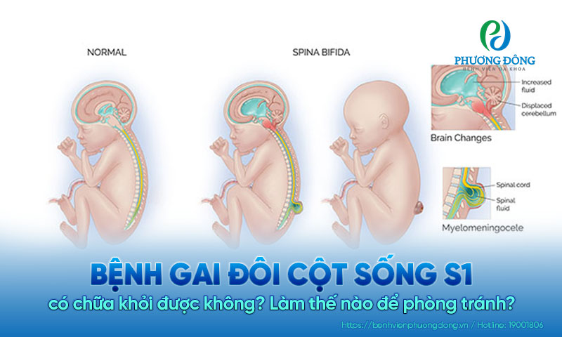 Bệnh gai đôi cột sống S1 có chữa khỏi được không? Làm thế nào để phòng tránh?