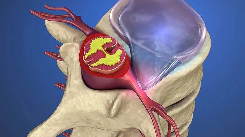 Bệnh nhân có thể gặp biến chứng thoát vị đĩa đệm