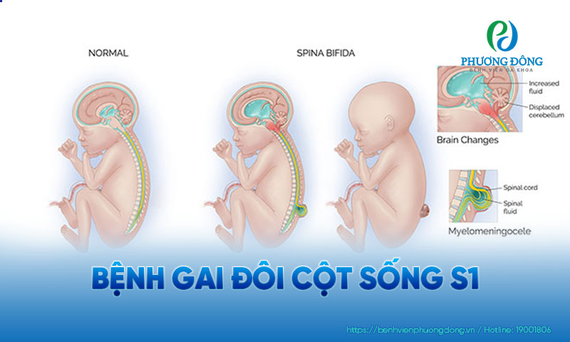 Gai đôi cột sống là một trong số các dị tật bẩm sinh