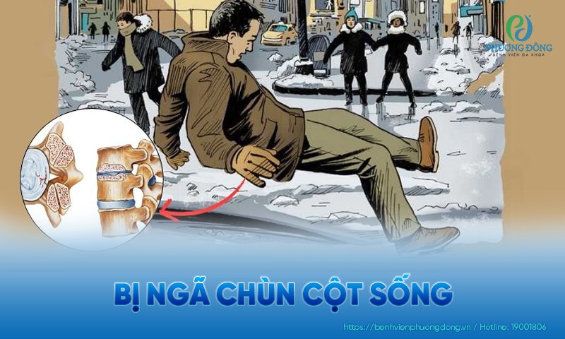 Bị ngã chùn cột sống: Dấu hiệu, điều trị và cách phòng ngừa