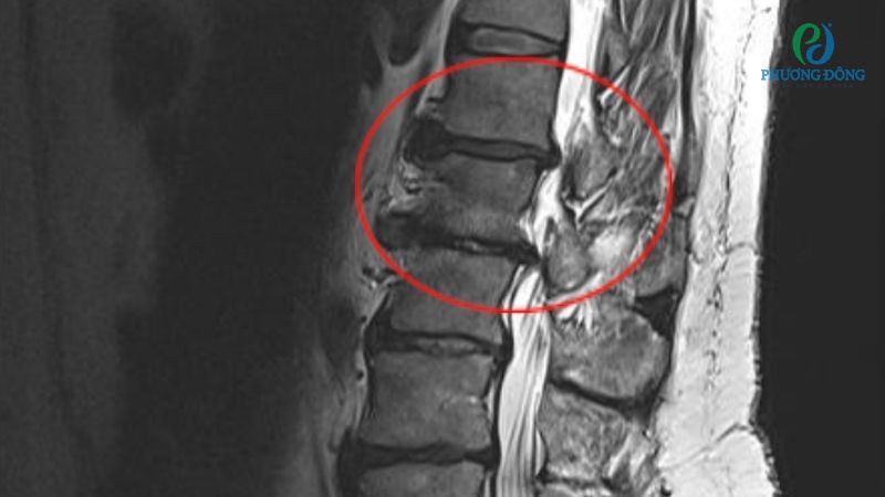 Phương pháp chẩn đoán cột sống bị lún xẹp do chấn thương ngã