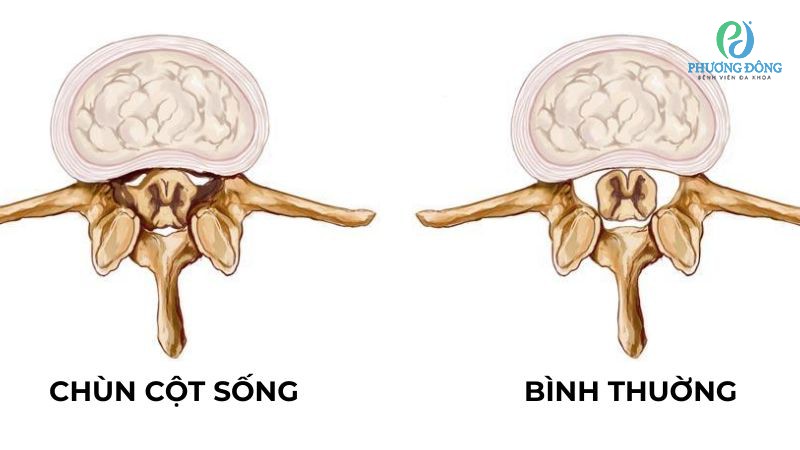 Biện pháp phòng ngừa bị ngã chùn cột sống