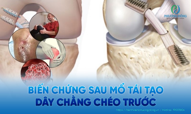 Biến chứng sau mổ tái tạo dây chằng chéo trước. Cách phòng ngừa Biến chứng sau mổ tái tạo dây chằng chéo trước. Cách phòng ngừa