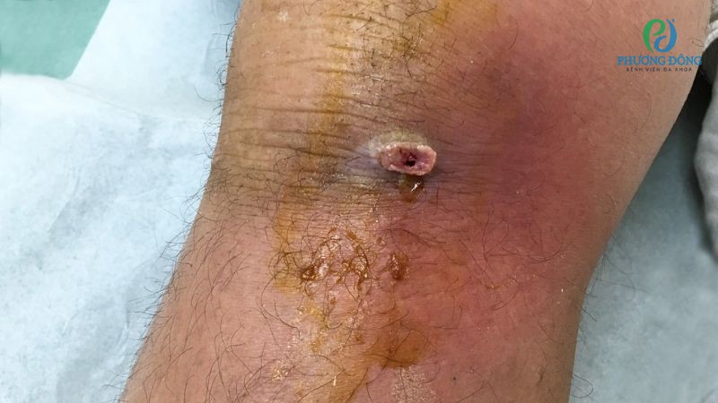 Nhiễm trùng là 1 trong 5 biến chứng sau mổ tái tạo dây chằng chéo trước