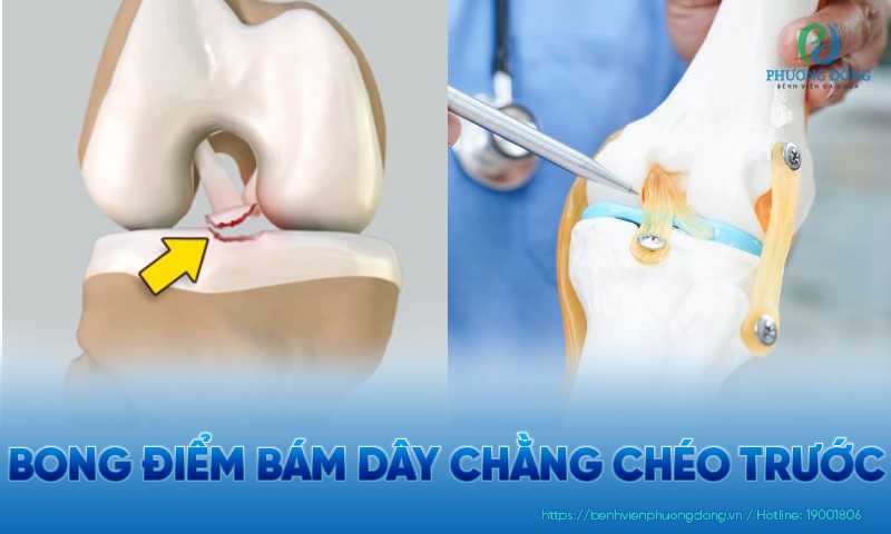 Bong điểm bám dây chằng chéo trước: Phân loại, dấu hiệu và điều trị