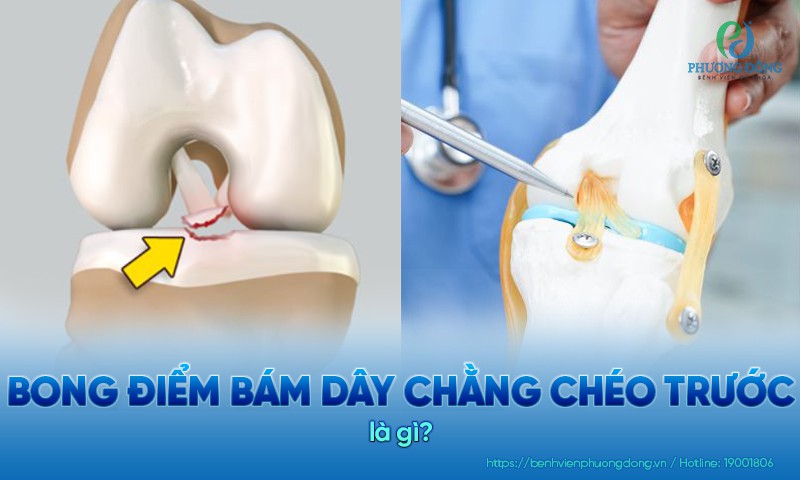 Bong điểm bám dây chằng chéo trước là tình trạng điểm bám dây chằng bị tách khỏi mâm chày
