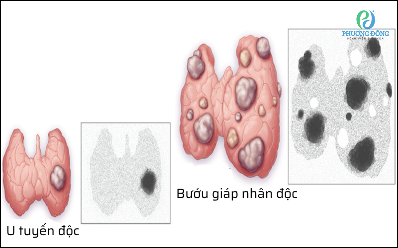 Bướu giáp đa nhân độc thường gây ra sự sản xuất hormone giáp quá mức