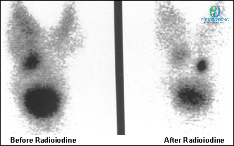 Liệu pháp iốt phóng xạ cho bệnh bướu giáp đa nhân nhiễm độc trước và sau