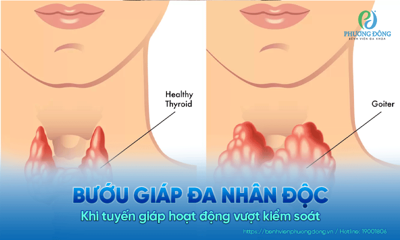 Bướu giáp đa nhân độc – Khi tuyến giáp hoạt động vượt kiểm soát Bướu giáp đa nhân độc – Khi tuyến giáp hoạt động vượt kiểm soát
