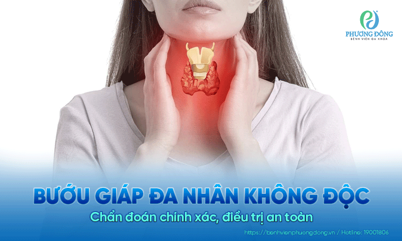 Bướu giáp đa nhân không độc: Chẩn đoán chính xác, điều trị an toàn