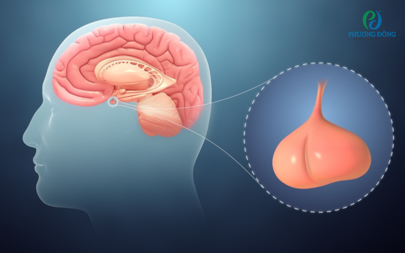 Suy tuyến yên là một trong các loại rối loạn nội tiết điển hình