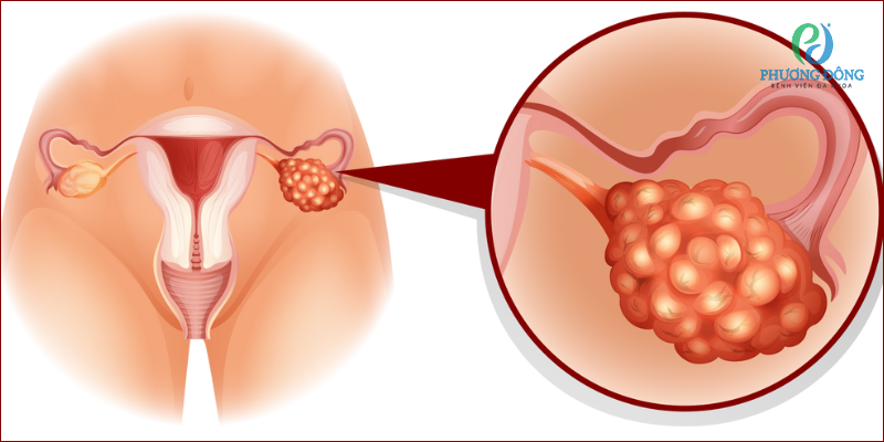 Hội chứng buồng trứng đa nang là một trong những rối loạn nội tiết phổ biến nhưng thường bị bỏ qua ở phụ nữ trong độ tuổi sinh sản.