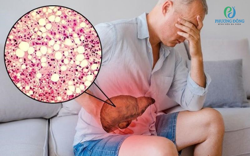 Men gan cao là tình trạng chỉ số men gan vượt mức cho phép