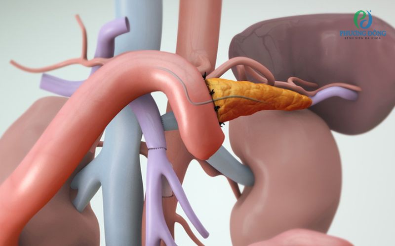 Phẫu thuật cắt khối tá tuỵ: Những điều cần biết