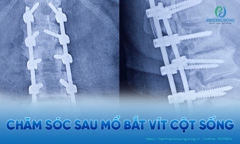 Chăm sóc sau mổ bắt vít cột sống tại bệnh viện và khi về nhà