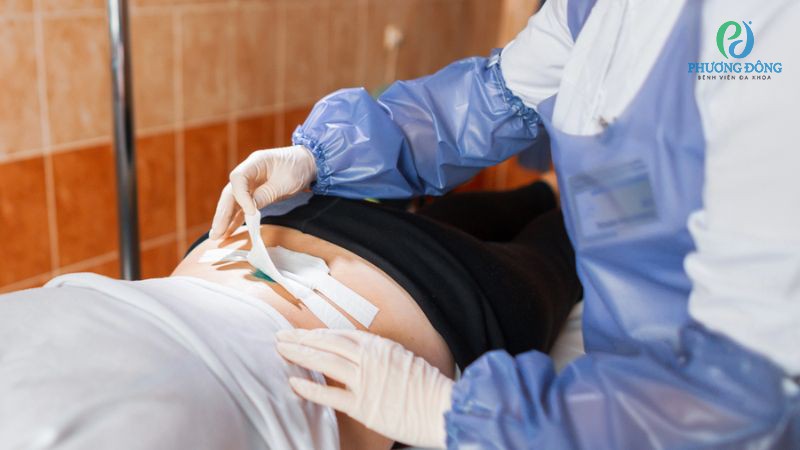 Trong thời gian nằm viện bệnh nhân sẽ được vệ sinh vết mổ đều đặn 2 ngày 1 lần