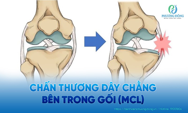 Chấn thương dây chằng bên trong gối (MCL): Triệu chứng, nguyên nhân và điều trị