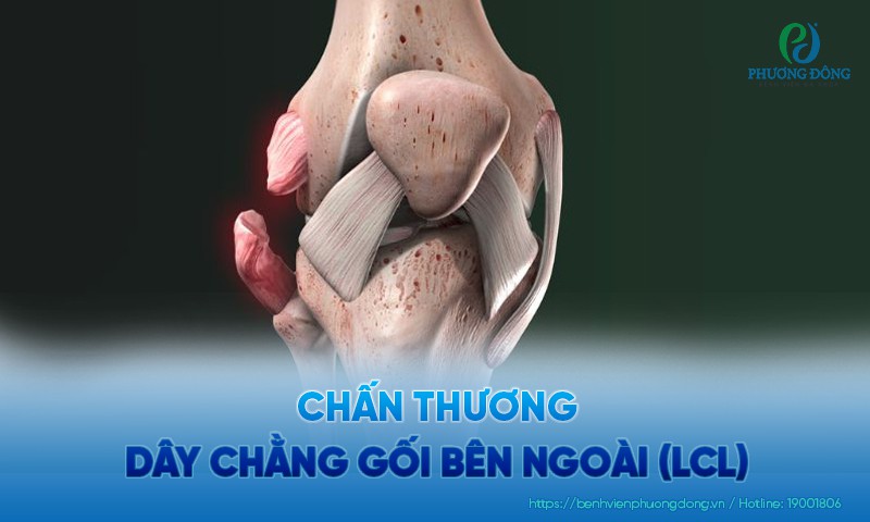 Chấn thương dây chằng gối bên ngoài (LCL): Nguyên nhân và hướng điều trị