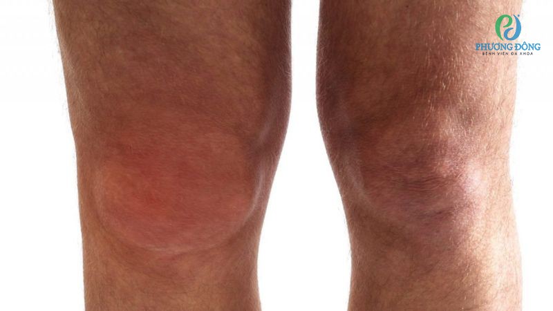 Dấu hiệu nhận biết dây chằng gối bên ngoài bị chấn thương