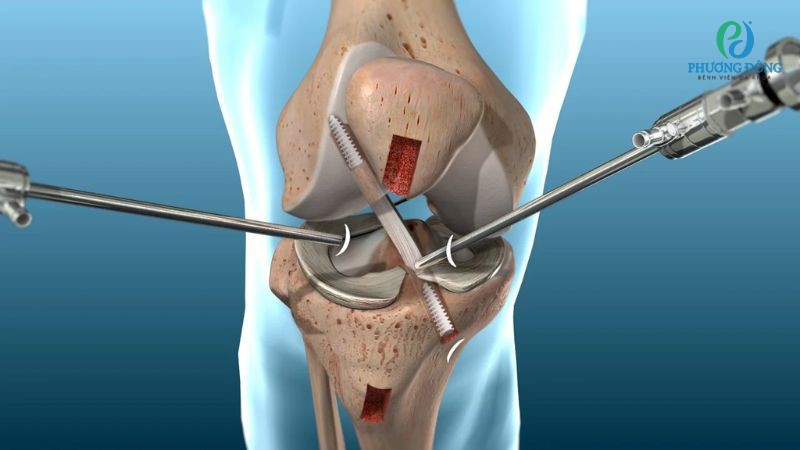 Can thiệp ngoại khoa đối với những trường hợp rách hoàn toàn hoặc mất vững khớp gối